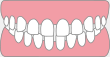 すきっ歯が悩み